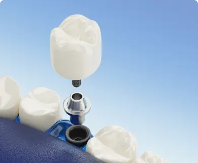 DrBraces Karnataka Largest Invisalign Provider